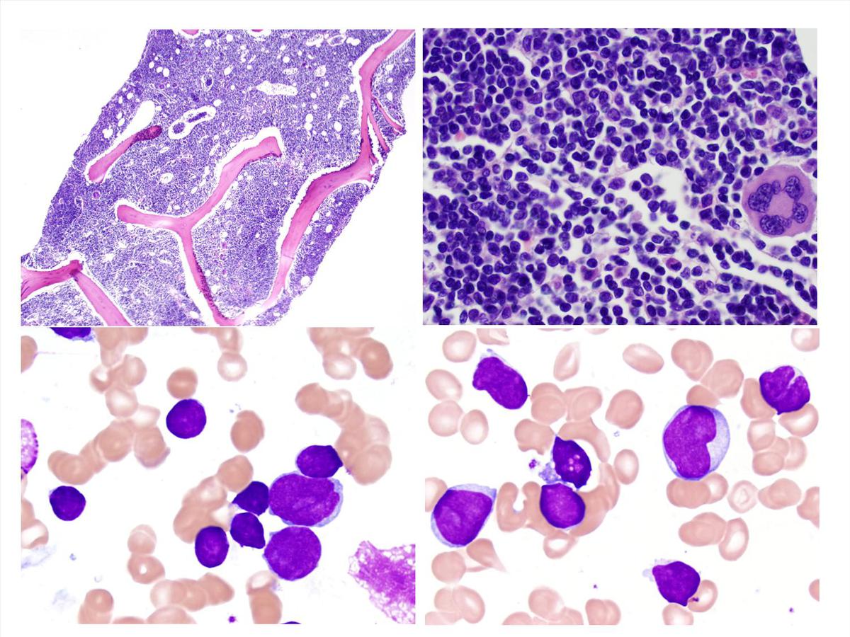 Biopsy and aspirate at diagnosis